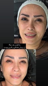 سالن زیبایی مرکاتو فیشال پاکسازی پوست اسیدتراپی در شمس آباد هروی 13