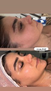 سالن زیبایی مرکاتو فیشال پاکسازی پوست اسیدتراپی در شمس آباد هروی 6