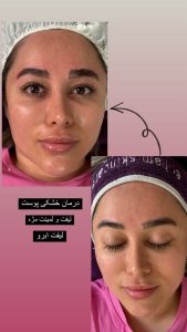 سالن زیبایی مرکاتو فیشال پاکسازی پوست اسیدتراپی در شمس آباد هروی 7