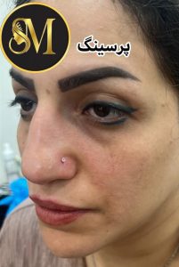 سالن زیبایی مهر مزونیدلینگ ژل لب تزریق بوتاکس در هفت تیر قم 10