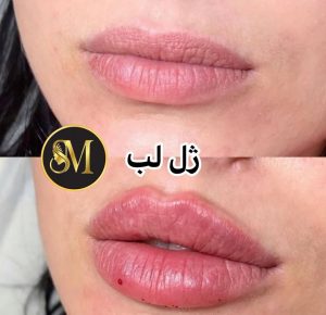 سالن زیبایی مهر مزونیدلینگ ژل لب تزریق بوتاکس در هفت تیر قم 8