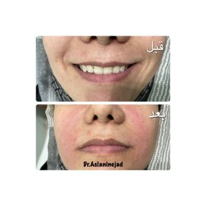 ‏زیبایی ‏ثمینا ‏بیوتی ‏جوانسازی ‏هایفوتراپی ‏مزوژل ‏در ‏دردشت ‏جنوبی 2