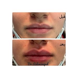 ‏زیبایی ‏ثمینا ‏بیوتی ‏جوانسازی ‏هایفوتراپی ‏مزوژل ‏در ‏دردشت ‏جنوبی 4