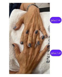 ‏رام ‏برزین ‏بوتاکس ‏ژل ‏هایفو ‏فیشیال ‏در ‏مشهد ‏کوثر