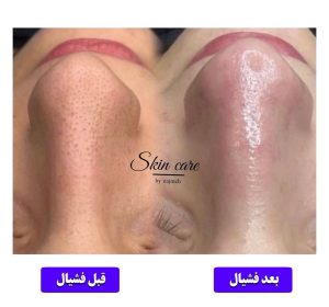 ‏رام ‏برزین ‏بوتاکس ‏ژل ‏هایفو ‏فیشیال ‏در ‏مشهد ‏کوثر 4