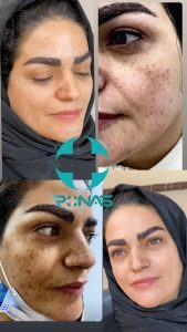 کلینیک تخصصی جوانسازی روناس رفع کک و مک رفع واریس در بوشهر باغ زهرا 6