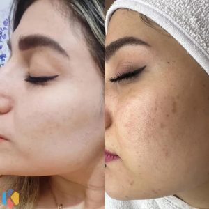 زیبایی مهراد فیشال مزوتراپی مزونیدلینگ در گوهردشت کرج 2 result