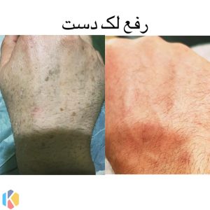 زیبایی مهراد فیشال مزوتراپی مزونیدلینگ در گوهردشت کرج result