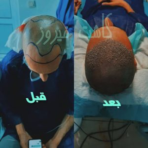 کلینیک شیرازی خدمات کاشت مو شیرازی و کاشت ابرو و پرپشت کننده مو در تهران نارمک 10