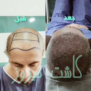 کلینیک شیرازی خدمات کاشت مو شیرازی و کاشت ابرو و پرپشت کننده مو در تهران نارمک 11