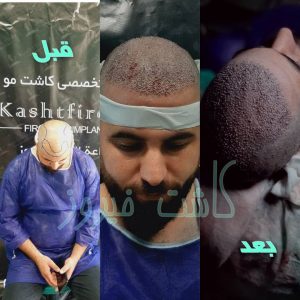کلینیک شیرازی خدمات کاشت مو شیرازی و کاشت ابرو و پرپشت کننده مو در تهران نارمک 12
