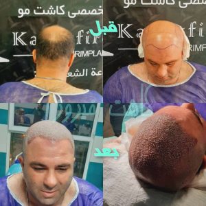 کلینیک شیرازی خدمات کاشت مو شیرازی و کاشت ابرو و پرپشت کننده مو در تهران نارمک 13