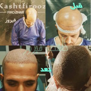 کلینیک شیرازی خدمات کاشت مو شیرازی و کاشت ابرو و پرپشت کننده مو در تهران نارمک 14