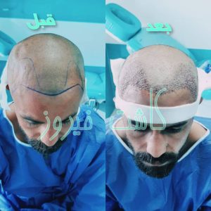 کلینیک شیرازی خدمات کاشت مو شیرازی و کاشت ابرو و پرپشت کننده مو در تهران نارمک 15