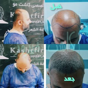 کلینیک شیرازی خدمات کاشت مو شیرازی و کاشت ابرو و پرپشت کننده مو در تهران نارمک 17