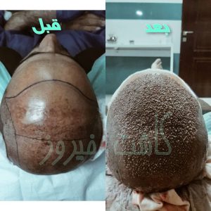 کلینیک شیرازی خدمات کاشت مو شیرازی و کاشت ابرو و پرپشت کننده مو در تهران نارمک 3