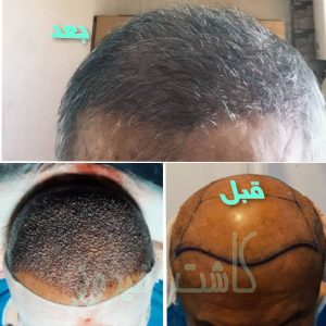 کلینیک شیرازی خدمات کاشت مو شیرازی و کاشت ابرو و پرپشت کننده مو در تهران نارمک 4