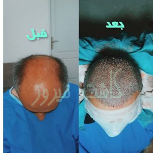 کلینیک شیرازی خدمات کاشت مو شیرازی و کاشت ابرو و پرپشت کننده مو در تهران نارمک 5