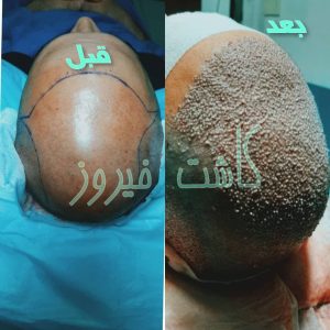 کلینیک شیرازی خدمات کاشت مو شیرازی و کاشت ابرو و پرپشت کننده مو در تهران نارمک 6