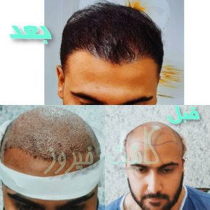 کلینیک شیرازی خدمات کاشت مو شیرازی و کاشت ابرو و پرپشت کننده مو در تهران نارمک 7