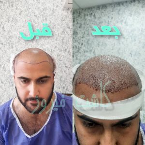 کلینیک شیرازی خدمات کاشت مو شیرازی و کاشت ابرو و پرپشت کننده مو در تهران نارمک 8