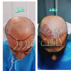 کلینیک شیرازی خدمات کاشت مو شیرازی و کاشت ابرو و پرپشت کننده مو در تهران نارمک 9