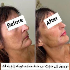کلینیک ‏دکتر ‏نیلوفر ‏افخمی ‏هیرفیلر ‏پروفایلو ‏جالپرو ‏در ‏مشهد ‏سجاد ‏خیام 6