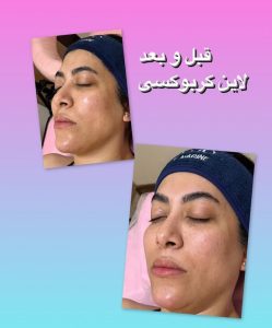 شیرین ‏اسکین ‏کر ‏خدمات ‏پاکسازی ‏پوست ‏اسیدتراپی ‏کربوکسی ‏تراپی ‏خدمات ‏پلاژن ‏تراپی ‏در ‏تهران ‏شهر ‏آرا 17