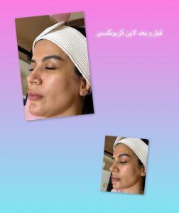 شیرین ‏اسکین ‏کر ‏خدمات ‏پاکسازی ‏پوست ‏اسیدتراپی ‏کربوکسی ‏تراپی ‏خدمات ‏پلاژن ‏تراپی ‏در ‏تهران ‏شهر ‏آرا 18