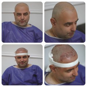 مو در تهرانپارس کاشت مو و ابرو بصورت جشنواره های تخفیف ویژه نقدی و جشنواره اقساطی در تهران 2