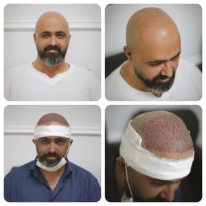 مو در تهرانپارس کاشت مو و ابرو بصورت جشنواره های تخفیف ویژه نقدی و جشنواره اقساطی در تهران 3