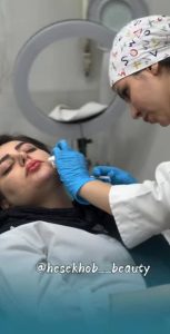 زیبایی حس خوب تزریق فیلر فیشیال لیزر در کاشان میدان جهاد۲