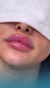 زیبایی حس خوب تزریق فیلر فیشیال لیزر در کاشان میدان جهاد۴