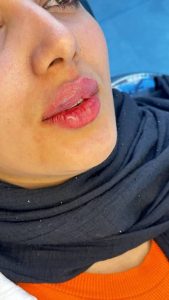 ‏زیبایی ‏توکا ‏ژل ‏بوتاکس ‏و ‏هایفو ‏لیزر ‏در ‏نازی ‏آباد 8