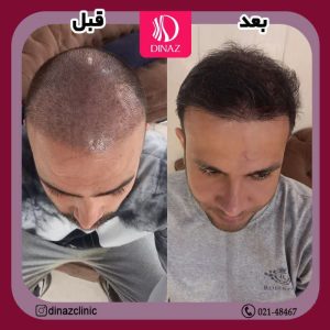کلینیک ‏زیبایی ‏دیناز ‏خدمات ‏کاشت ‏مو ‏و ‏کاشت ‏ابرو ‏و ‏بلفاروپلاستی ‏در ‏تهران ‏سعادت ‏آباد ‏میدان ‏کتاب 6