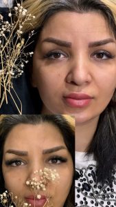 زیبایی الی بیوتی خدمات فیشال پاکسازی پوست لیفت جوانسازی مزونیدلینگ در تهران پاسداران 12