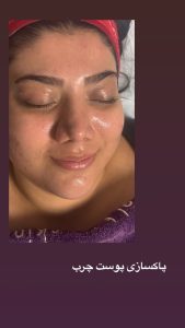 زیبایی الی بیوتی خدمات فیشال پاکسازی پوست لیفت جوانسازی مزونیدلینگ در تهران پاسداران 3