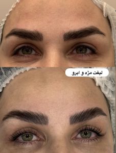 زیبایی الی بیوتی خدمات فیشال پاکسازی پوست لیفت جوانسازی مزونیدلینگ در تهران پاسداران 4