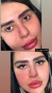 زیبایی الی بیوتی خدمات فیشال پاکسازی پوست لیفت جوانسازی مزونیدلینگ در تهران پاسداران 9