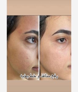 دکتر قدیانی فر خدمات تزریق بوتاکس مزوژل مزوتراپی در تهران زعفرانیه 20
