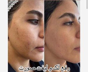 دکتر قدیانی فر خدمات تزریق بوتاکس مزوژل مزوتراپی در تهران زعفرانیه 21