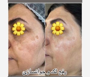 دکتر قدیانی فر خدمات تزریق بوتاکس مزوژل مزوتراپی در تهران زعفرانیه 22