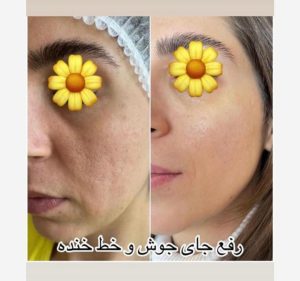 دکتر قدیانی فر خدمات تزریق بوتاکس مزوژل مزوتراپی در تهران زعفرانیه 23