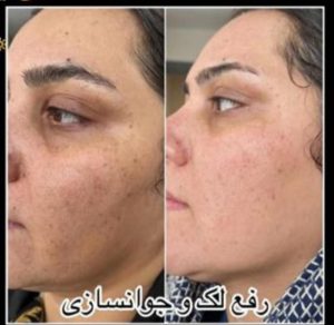 دکتر قدیانی فر خدمات تزریق بوتاکس مزوژل مزوتراپی در تهران زعفرانیه 26