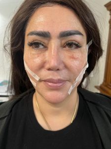 کلینیک ‏دکتر ‏کاشانی ‏لیزر ‏مزوتراپی ‏اندولیفت ‏در ‏تهران پاسداران 4